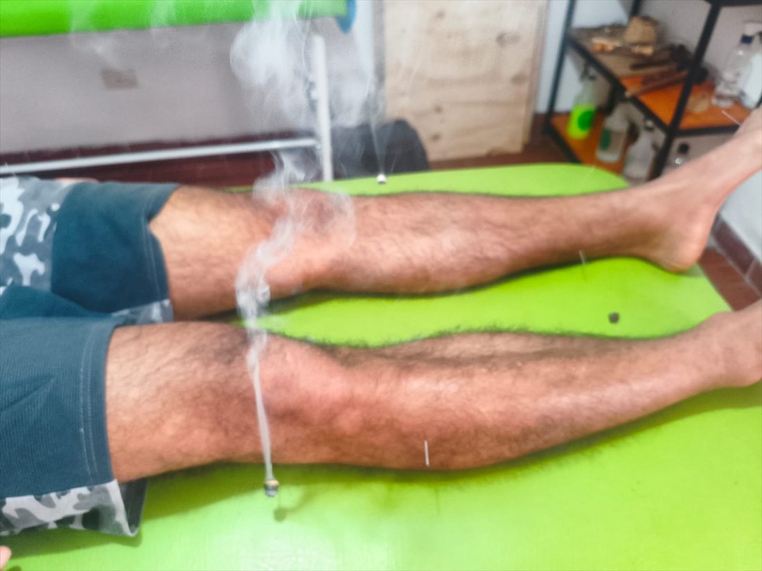 Moxibustión con artemisa y agujas sobre las piernas